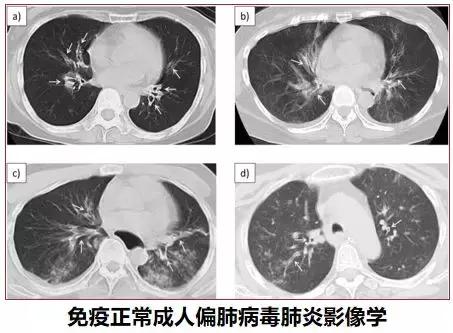 非肺炎最新情况分析